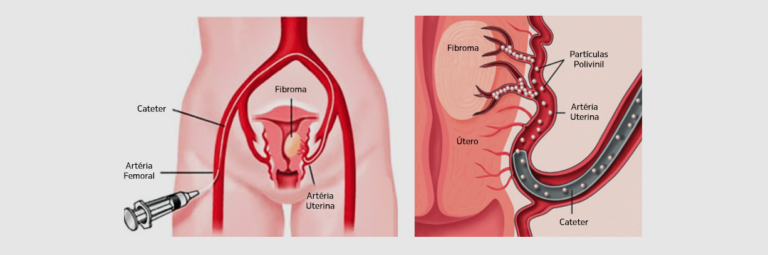 embolização de mioma uterino